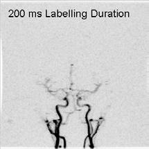 MRA (Arterial Spin Label based) TI=800 ms c/o