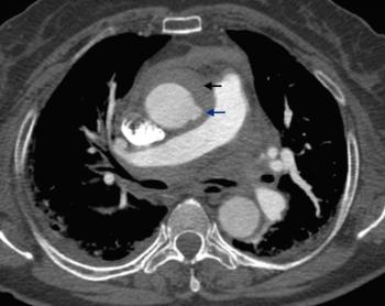 Pericardial hemorrhagic effusion (blue arrow) and stranding of the mediastinal fat planes (red arrow) are also seen.