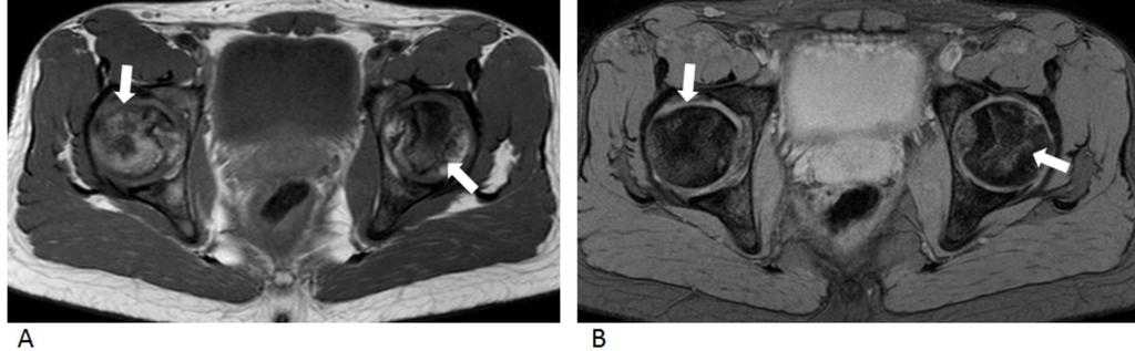 Fig. 8: Same patient that figure 5. MR T1 weighted image showing bilateral femoral heads osteonecrosis (arrows): low-signal-intensity line of uniform width in a subchondral location. Fig.