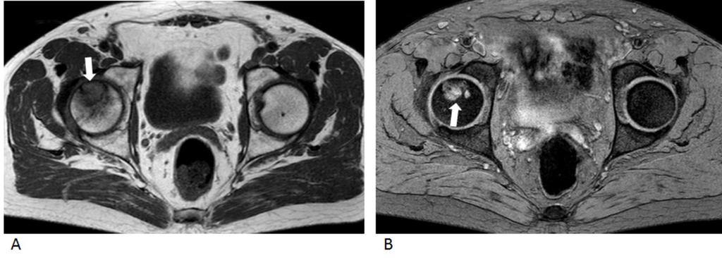 ) and T2 weighted image showing bilateral double line sign (arrows) - serpiginous low-signal-intensity line of uniform width on T1-weighted image and T2-weighted image, with an adjacent rim of