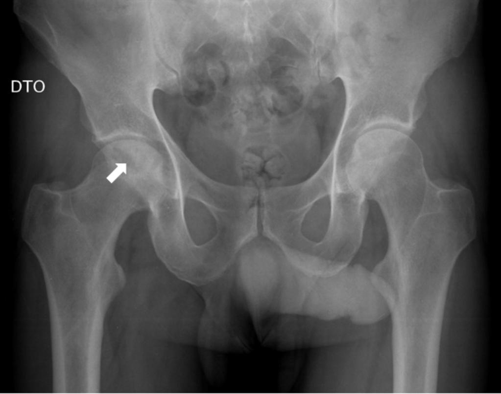 Fig. 1: Anteroposterior radiography of the pelvis showing a patchy lytic and sclerotic area (arrow) in the right