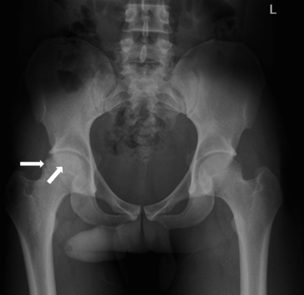 Fig. 2: Pelvis anteroposterior radiography of a 21 years old man medicated with corticoids.