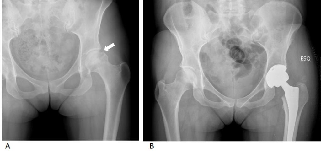 lucency (arrow) in the right femoral head. Fig.