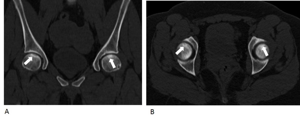 Fig. 5: Bilateral osteonecrosis. Coronal (A.) and Axial (B.