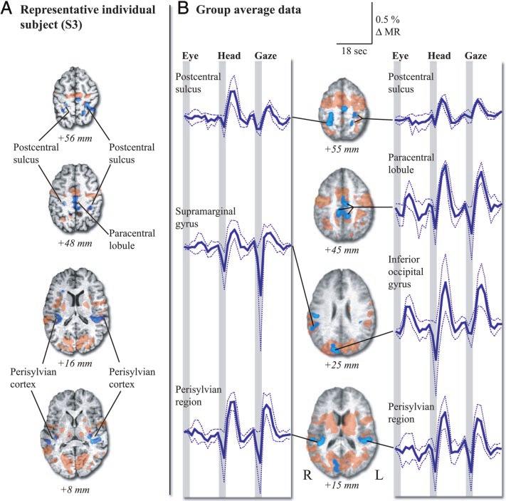 Note that the collicular activation is located inferior and posterior to thalamic activity in the lateral geniculate nucleus (visible in S2, S3, very prominent in S4 and S5).