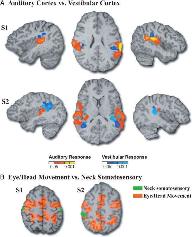 2524 L. PETIT AND M. S. BEAUCHAMP FIG. 7. Comparison between activity evoked by head movements and activity evoked by auditory and somatosensory stimulation in 2 subjects (S1 and S2).
