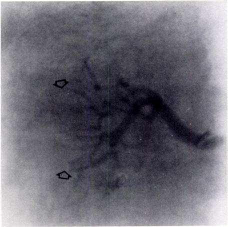 Renal CO 2 Arteriogram AJR139:19,1982 CO 2