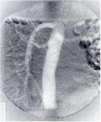 Renal CO 2 DSA CO 2 aortogram in severely hypertensive man.