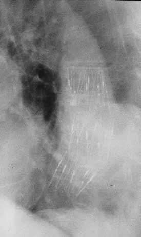 EDITORIAL CHD ACD ACD ET CSP TX Figure 2. Plain chest radiograph performed on postoperative day 1 (left) showing good stent-graft configuration and alignment within the descending thoracic aorta.