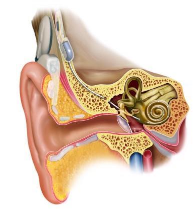 Cochlear Implants and its structure People have severe to profound hearing loss in a different age; this may happen by diseases, accident, age or Innate.