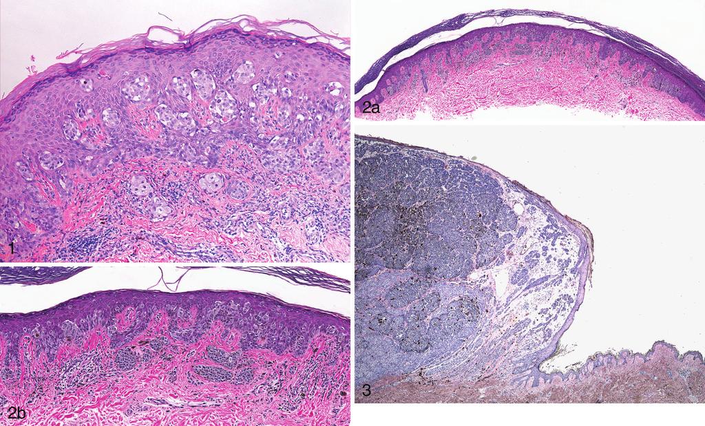 Figure 1. A superficial spreading melanoma characterized by nested and pagetoid proliferation of uniformly atypical epithelioid melanocytes in the epidermis.