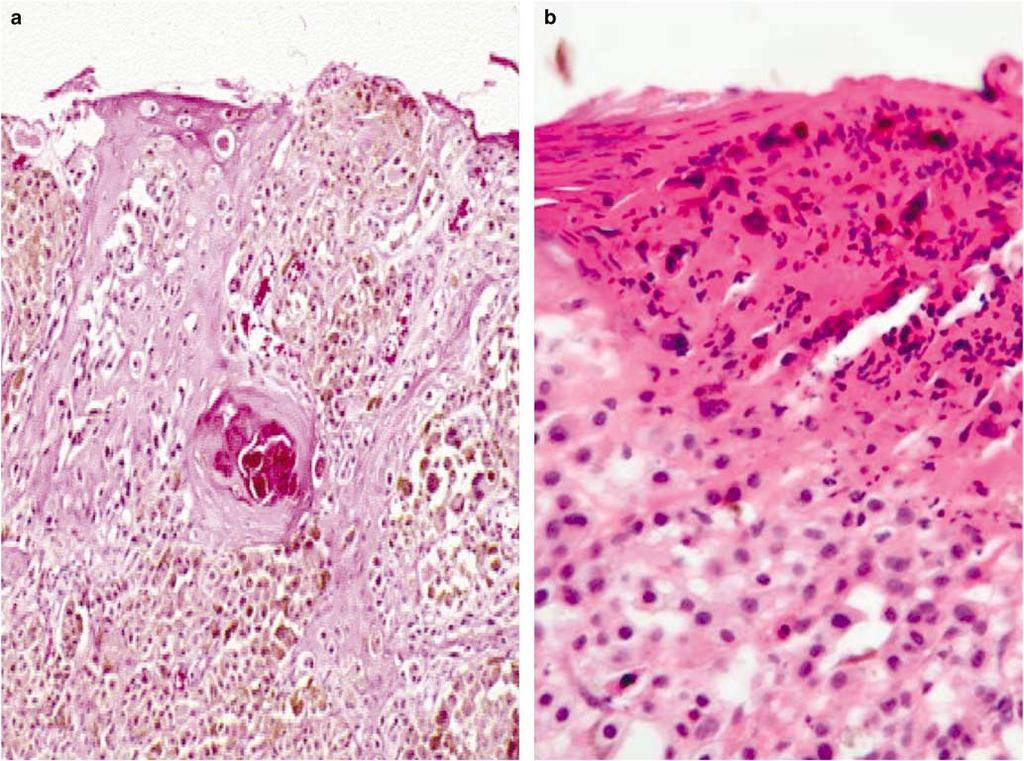 S80 Figure 8 Ulceration: Ulceration emerges as a powerful negative prognostic indicator. It is important not to misinterpret artifactual fragmentation of the epidermal surface (a) from ulceration (b).