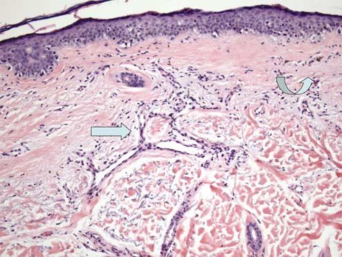 In the right half of the panel, tumor-infiltrating lymphocytes surround 90% of the peripheral margin of the melanoma nodule. Either of these two patterns constitutes a brisk lymphocytic infiltrate.