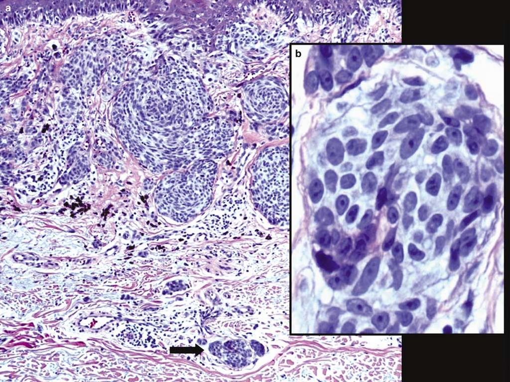 S78 Figure 6 Microscopic satellites: Microscopic satellites, in the most recent AJCC Classification scheme, are considered equivalent to an N1 lymph node metastatic station (a).