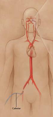 Endovascular Treatment of Aneurysms and Pseudoaneurysms UCSF Stroke and Aneurysm Update CME Saturday September 6, 2014 Steven W.