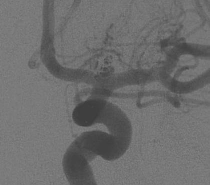 Efficacy 1 Year Angiographic All Unruptured Aneurysms (UIA) SAC N=114 Core Lab Occlusion Assessment CA