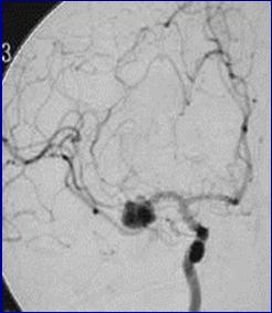 , MCA bifurcation) Ability to inspect aneurysm Hematoma requiring