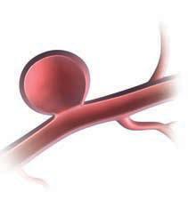 Aneurysms can be classified by size: