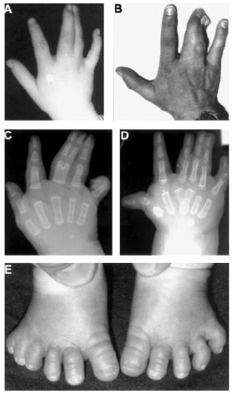 Synpolydactyly can be caused by alanine repeat expansions in Hox D13