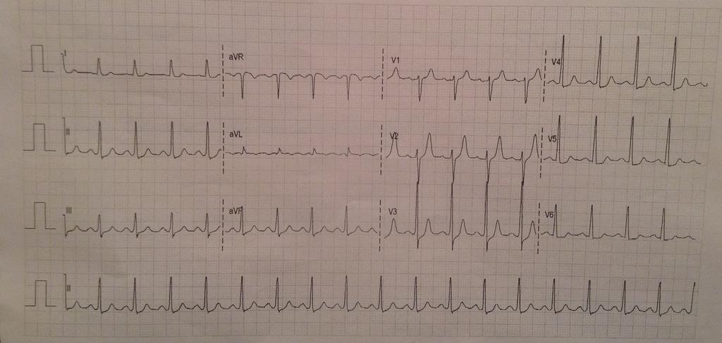 Normal P-QRS complexes Example of the appearance of a delta wave in red Figure 4. ECG following direct current cardioversion (DCC).