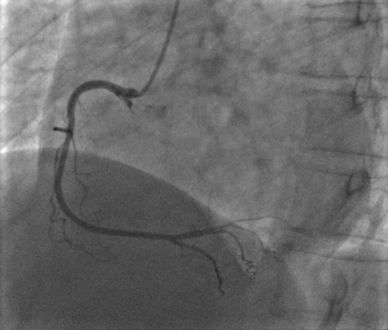 CASE REPORT Right Coronary Artery syndrome should be fully evaluated due to the risk of lethal arrhythmias (Blomström-Lundqvist et al., 2003).