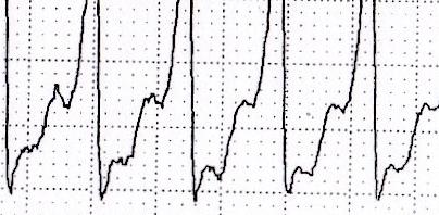 CASE REPORT Additionally, the patient presented acutely unwell with ECG findings of complex ventricular tachycardia.