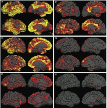 Beta Amyloid PET Scan PET scans revealed beta-amyloid plaque in the brains of three Alzheimer's disease patients (left) and three normal controls (right).