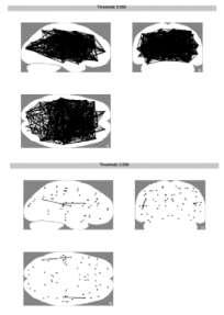 related to dementia: a MEG study using atlas-based beamforming. [Ponsen MM 2013].