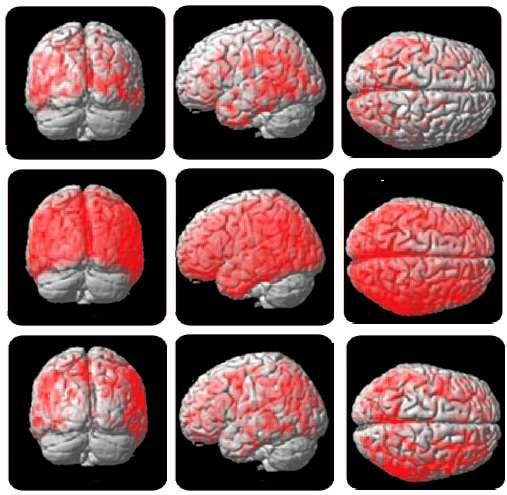 The role of functional and molecular neuroimaging Overview of studies According to the model, PD de NOVO/early PD, PDD exhibit a cholinergic degeneration across the entire cortex but most notably in