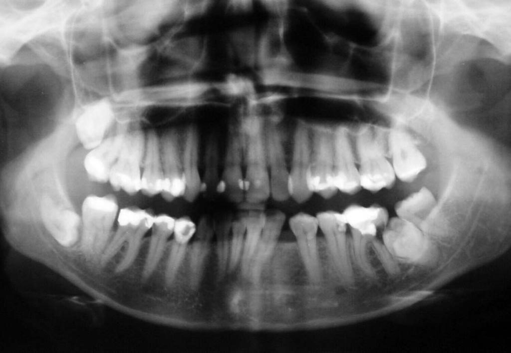 UPRIGHTING IMPACTED PERMANENT SECOND MOLARS 149 Figure 1. Panoramic radiograph of 24-year-old woman showing damage of first molar distal root by impacted left second molar.