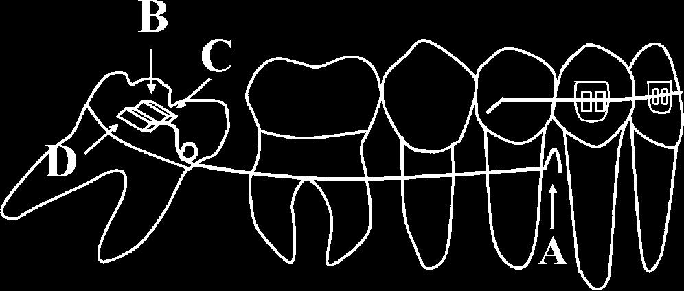 150 SAWICKA, RACKA-PILSZAK, ROSNOWSKA-MAZURKIEWICZ Figure 2. Forces delivered to the cantilever in the process of activation. Figure 3. Forces acting on the teeth.