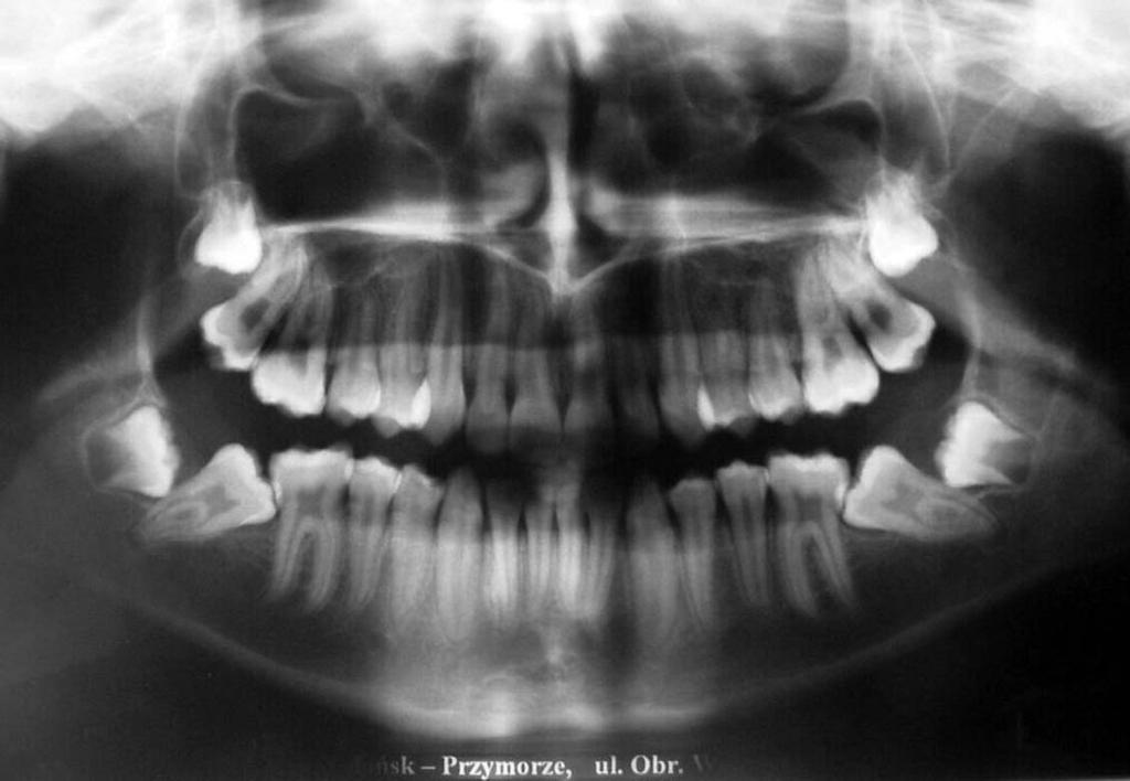 A panoramic radiograph revealed the presence of all permanent teeth and a severe mesial inclination of both the lower second molars and developing third molars (Figure 4).