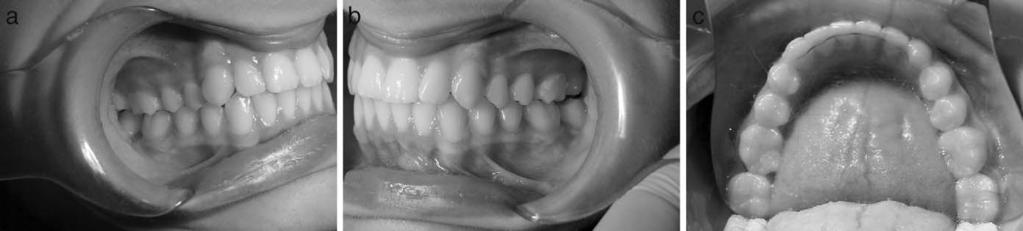 (A) and (B) Intraoral photographs after 5 months