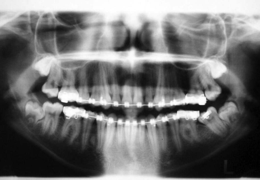 UPRIGHTING IMPACTED PERMANENT SECOND MOLARS 153 Figure 9. Panoramic radiograph showing impacted second molar crown blocked under the distal edge of incorrectly fitted band.
