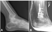 malleolus Syndesmotic Ligamentous complex of tibiofibular joint High ankle sprain Ankle Fracture Immobilization & Weight Bearing Lateral Malleolus Weight