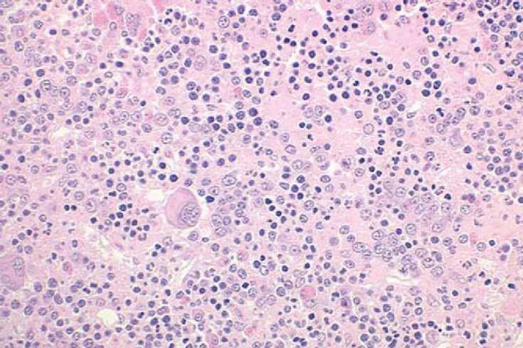 Polycythemia Vera Morphologic Features Hypercellular bone marrow Multilineage hyperplasia