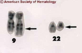 Philadelphia Chromosome The Philadelphia chromosome (Ph) is commonly found in hematologic malignancies CML: 90-95% Adult ALL: 20% Pediatric ALL:5% AML: 2% BCR-ABL