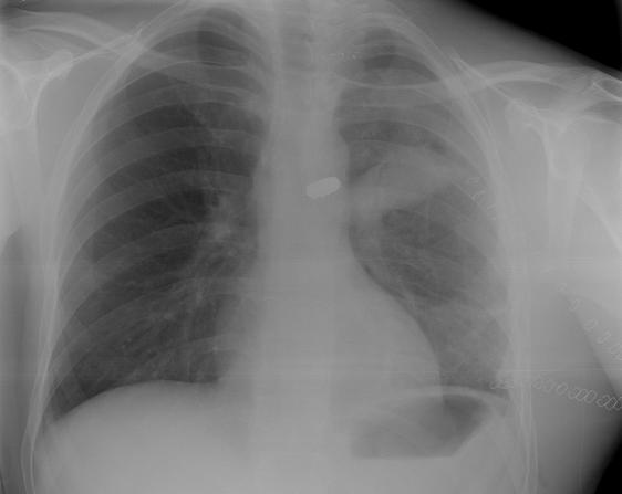 Radiology Corner Case # 26 Lung laceration with active bleeding, contusion and hemothorax Guarantor: LT Christopher Backus, USAF* Contributors: LT Christopher Backus, USAF*, COL Les Folio, MC, USAF,