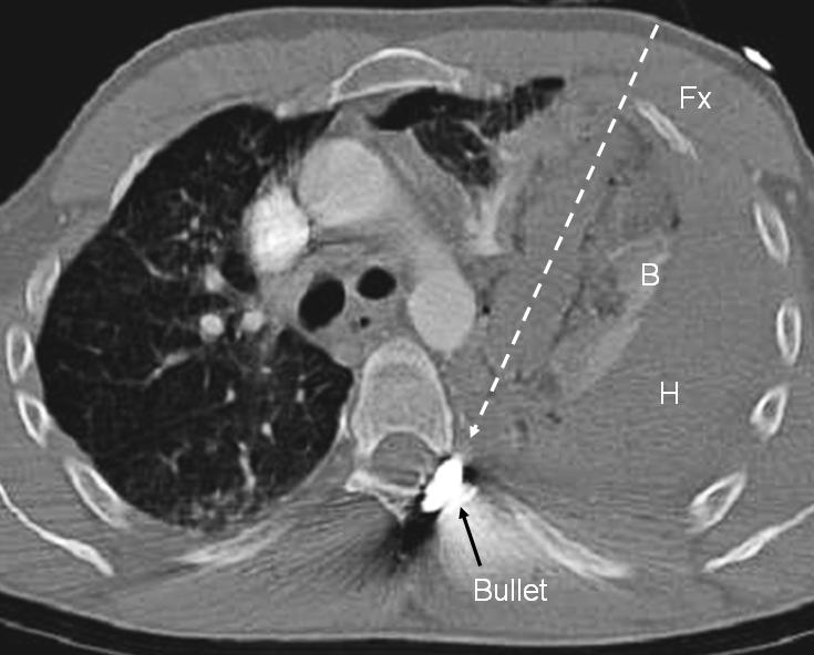 Fig. 2. The lung contusion seen on plain CXR is confirmed on the above para-axial CT reformatted through the missile path (dotted arrow).