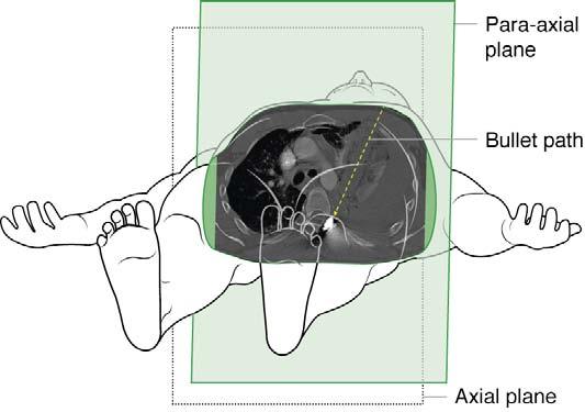Fig 7. Superiposition of the para-axial slice showing the bullet trajectory within the anatomic model from feet-up perspective.