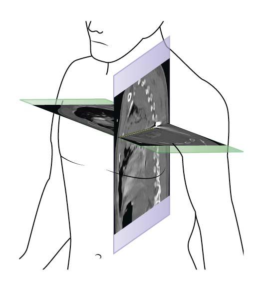 Anatomic superimposition of the tilted para-axial and parasagittal CT images with intersecting line to show bullet path on artist s anatomic model.