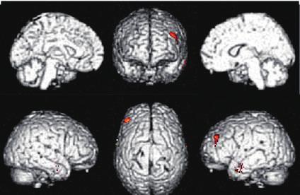 At baseline, regional hypometabolism through brain regions of the parietal cortex and temporo-occipital