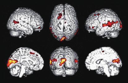Case 4 Fig. 3. Three patients showed changes in regional metabolism after cognitive therapy.
