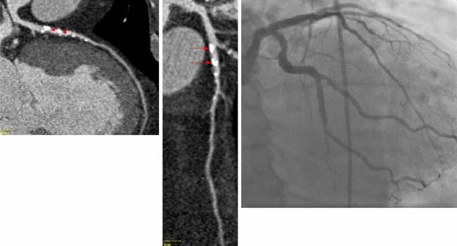 1164 Fig. 2 Left Contrast-enhanced dual-source ccta study in a 67- year-old man with substernal chest pressure.