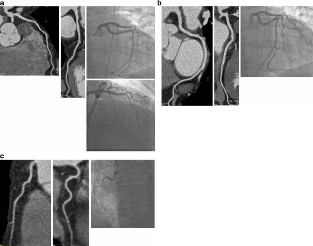 Right Coronary catheterization [a and b right anterior oblique [RAO] view; c LAO view] confirms patency of all four vessels Fig.