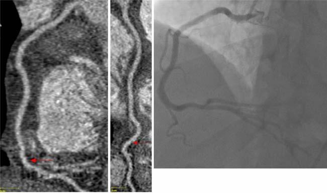 1165 Fig. 4 Left Contrast-enhanced 64-slice ccta study in a 49-year-old man with a body mass index of 38 kg/m 2 and prior abnormal nuclear myocardial perfusion study.