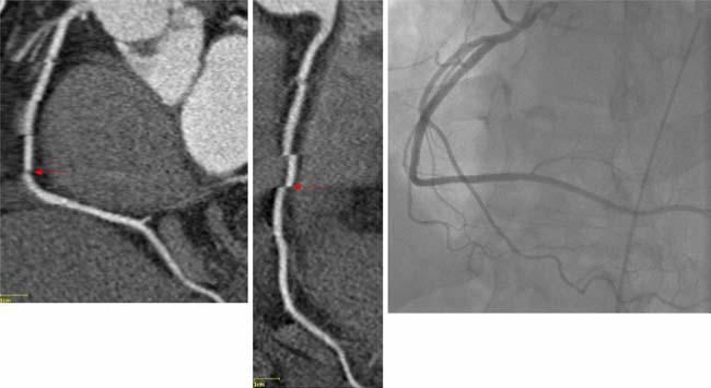 Right Coronary catheterization (LAO view) shows patency of the vessel Considering these findings, the algorithm in its current state appears more suitable for aiding the exclusion of significant