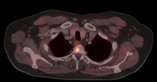 WB-MRI & PSMA-PET/CT can detect smaller lesions in asymtomatic patients with low, but