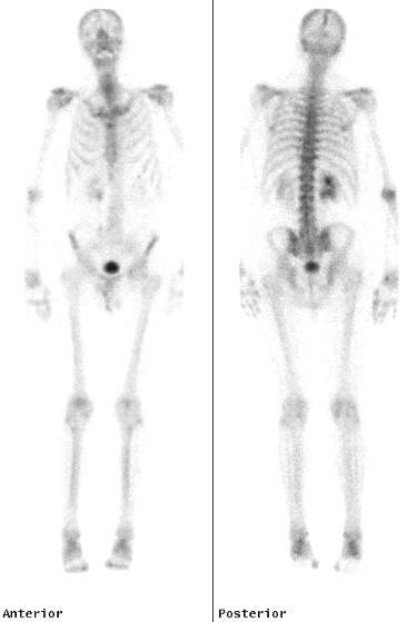 PSMA-PET/CT 61-year old with rising PSA after RP for pt3an0 PrCa, Gleason 10.
