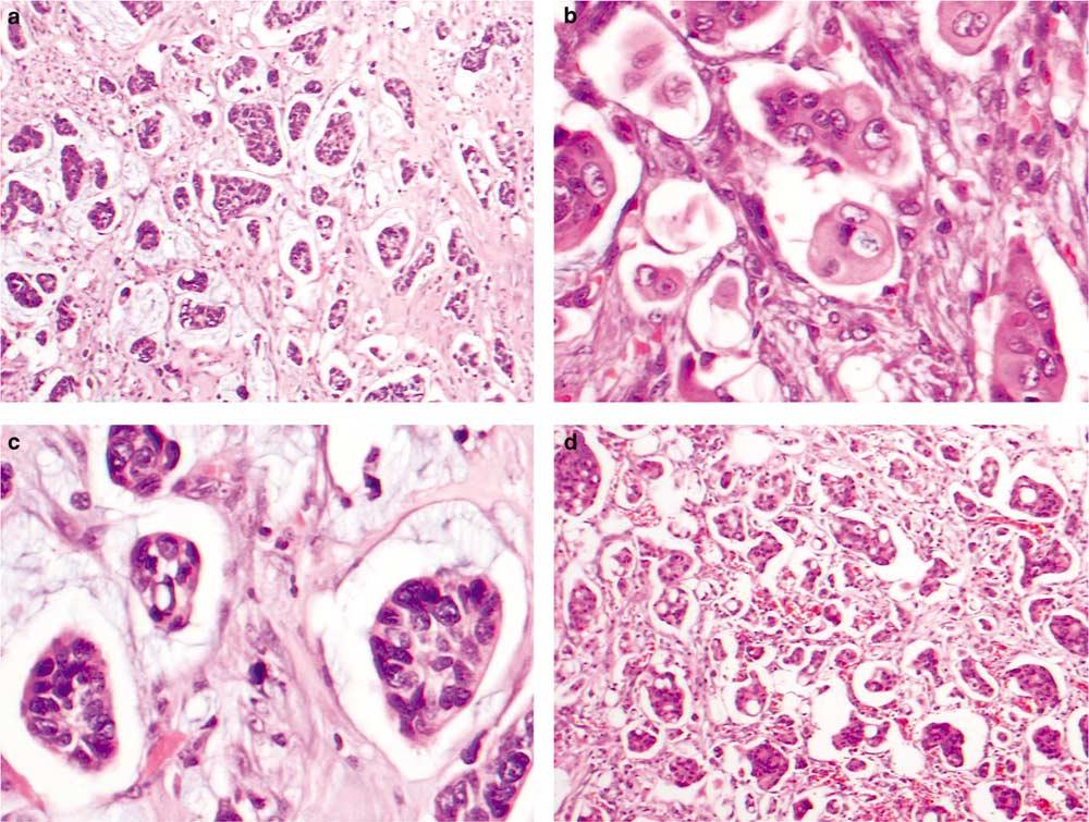 731 Figure 1 Primary and metastatic colorectal adenocarcinoma with micropapillary features.